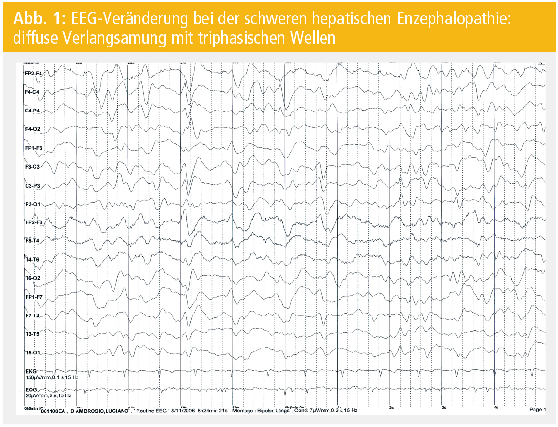 Hepatische Enzephalopathie Stadium 3 Lebenserwartung fity.club